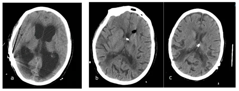 An infographic explaining what is NPH