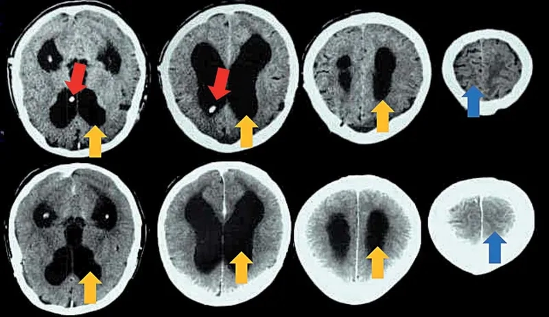 MRI brain scan showing enlarged ventricles in NPH