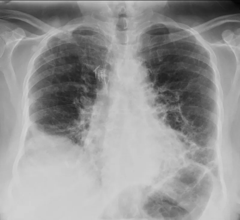 Learning what is asbestosis and its health impacts