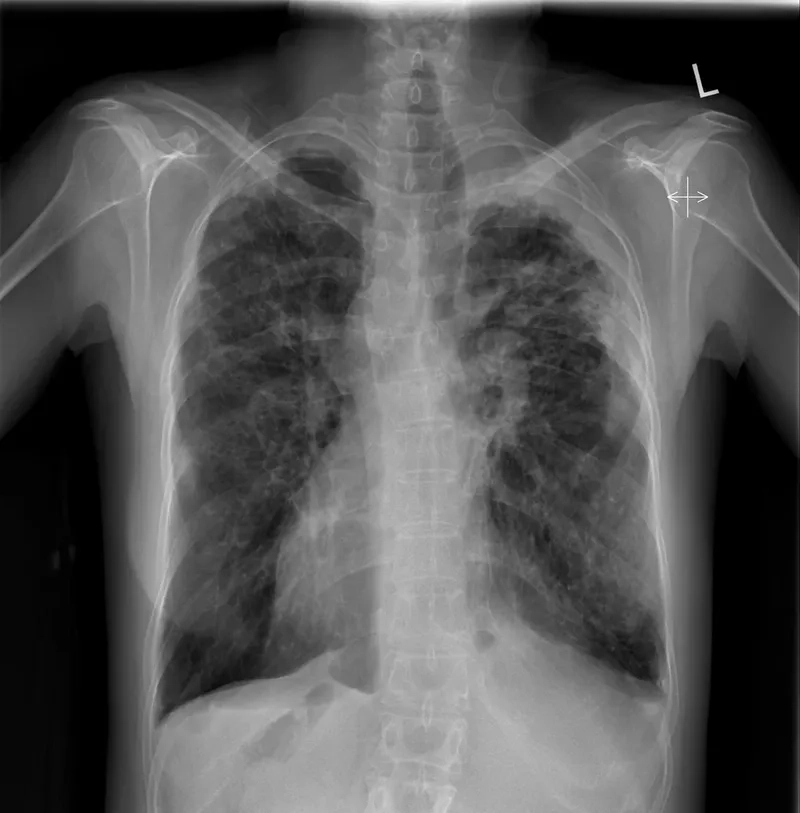 Recognizing asbestosis symptoms for early diagnosis