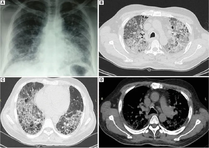 Addressing lung disease from dust exposure risks
