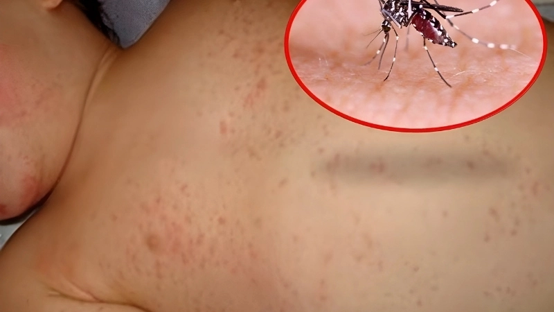 Learn the main Omsk Hemorrhagic Fever causes and risk factors