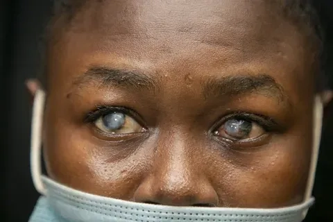 A patient displaying common onchocerciasis symptoms