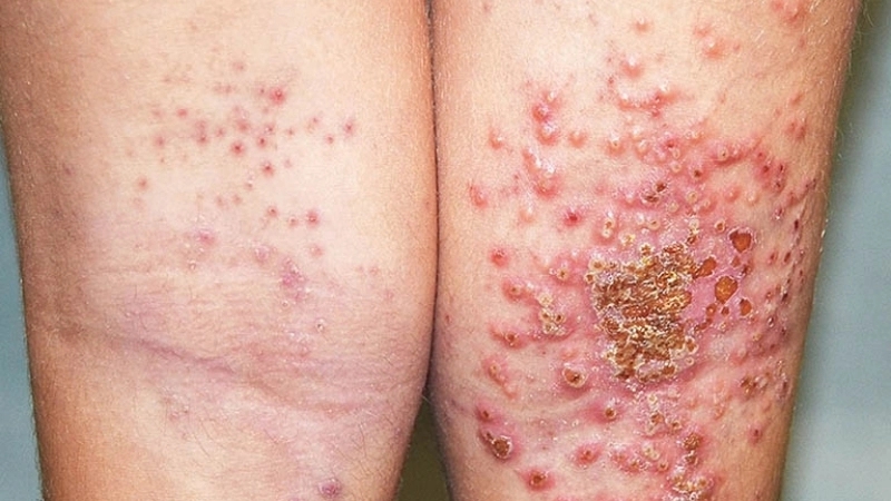 Orf contagious ecthyma ORF virus in goats