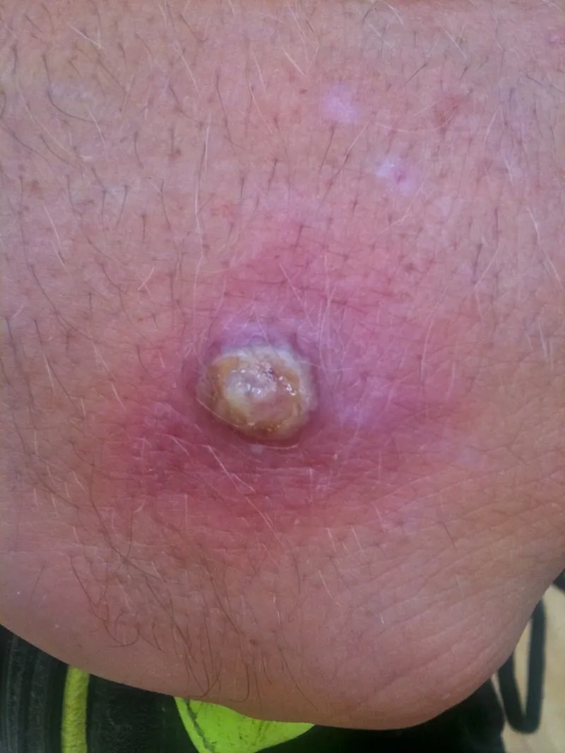 The progression of orf virus in humans