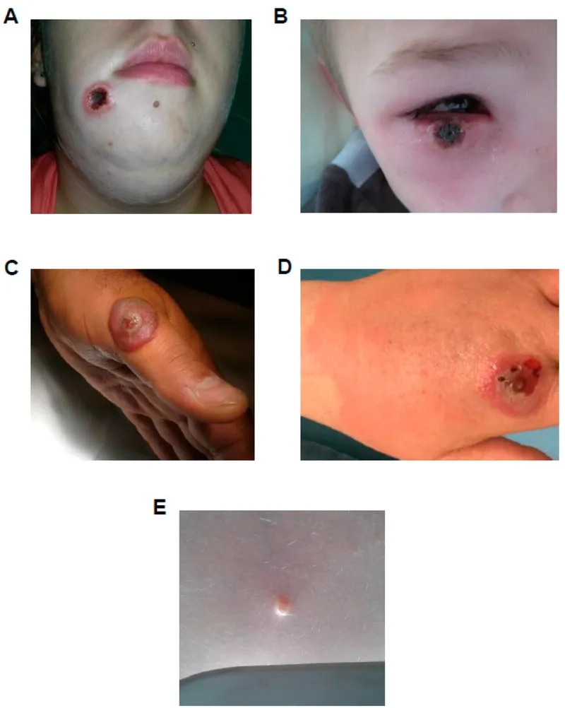 Effective orf virus treatment approaches