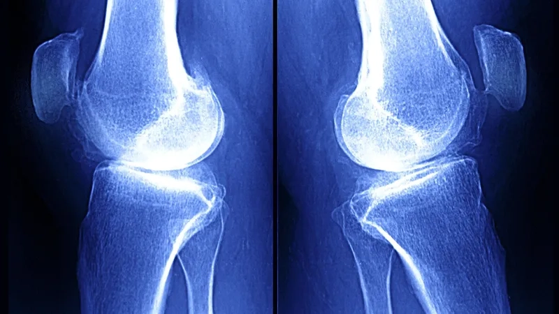 A chart comparing osteoarthritis vs rheumatoid arthritis symptoms