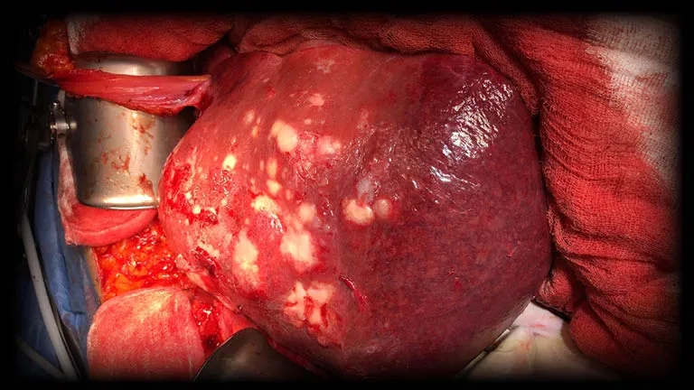 Ovarian cancer symptoms affecting women’s health