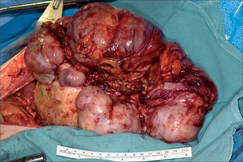 Ovarian cancer treatment and therapy options