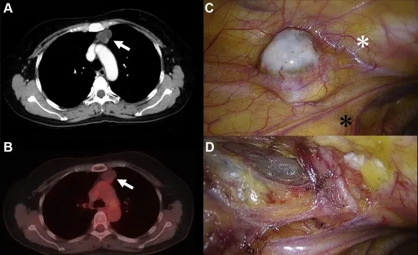 What is ovarian cancer explained in medical context