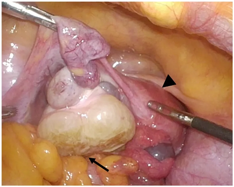 Stages of ovarian cancer from early to advanced