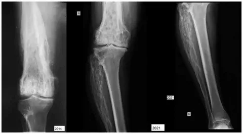 An explanation of the causes of Paget's disease