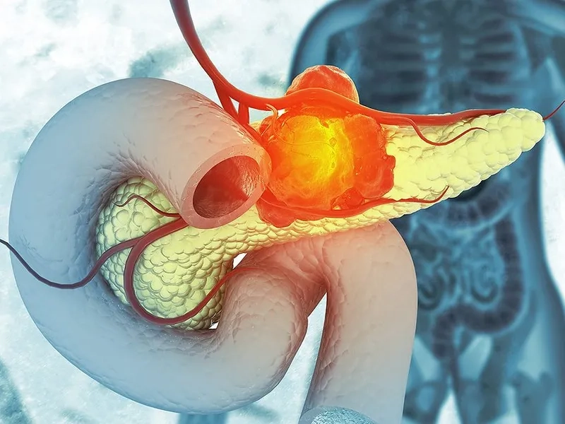 The four main stages of pancreatic cancer