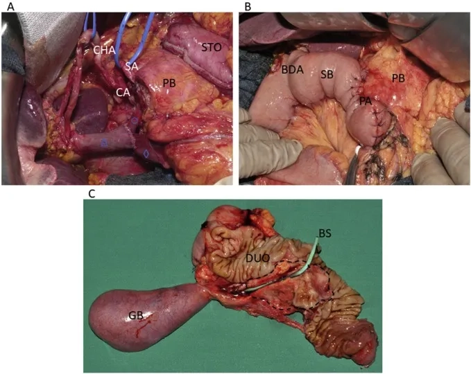 Managing treatment for stage 4 pancreatic cancer