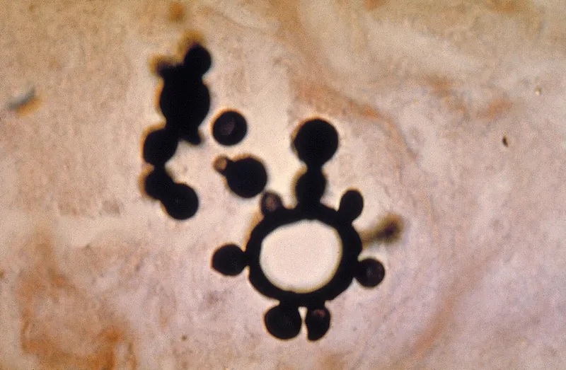 A patient exhibiting paracoccidioidomycosis symptoms