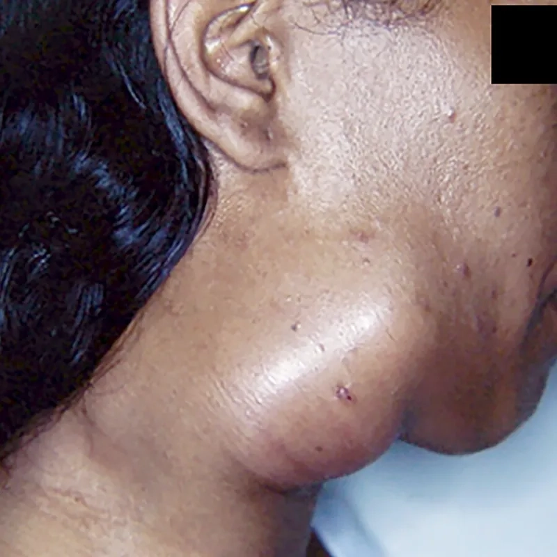 An illustration of a systemic fungal infection in the body