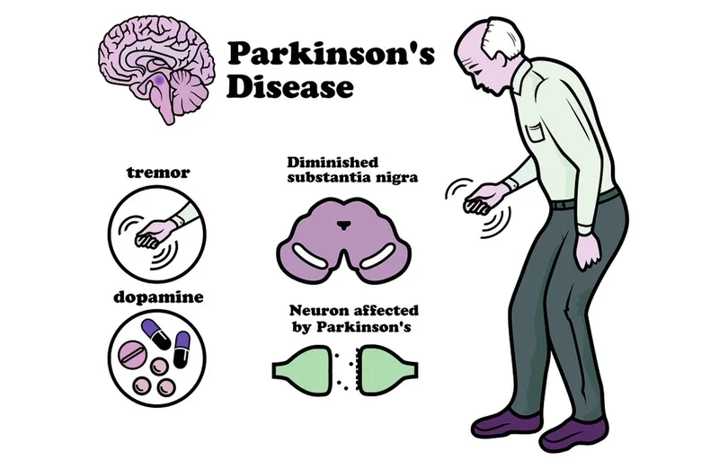 Recognizing the early signs of Parkinson's