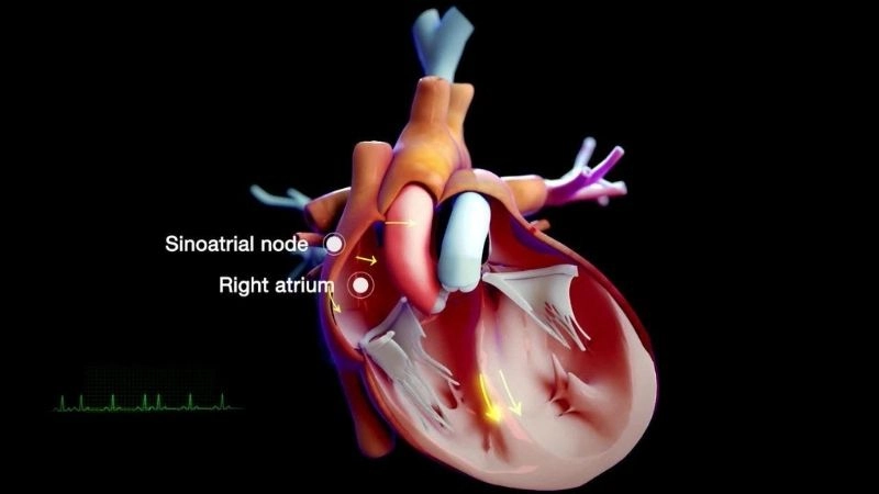 Paroxysmal Supraventricular Tachycardia and anxiety can worsen heart palpitations