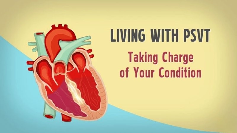 Living with PSVT needs lifestyle adjustments and medical guidance