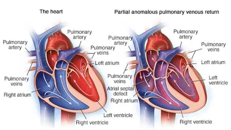 Partial anomalous pulmonary venous return symptoms overview