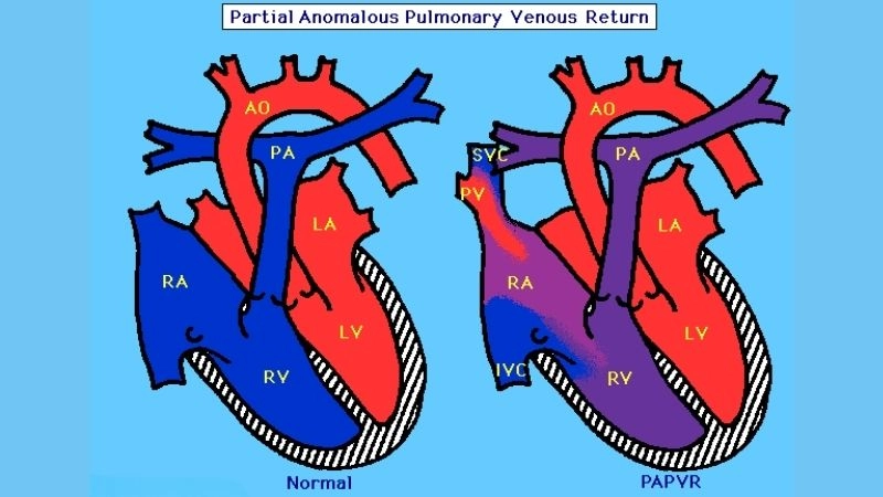 Partial anomalous pulmonary venous return treatment options