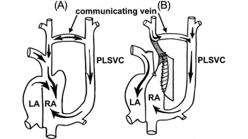 Partial anomalous pulmonary venous return surgery and repair
