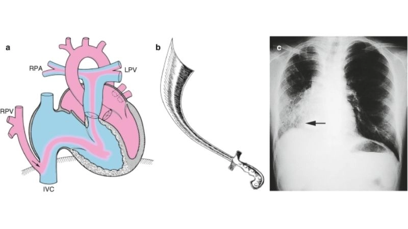Partial anomalous pulmonary venous return and atrial septal defect link