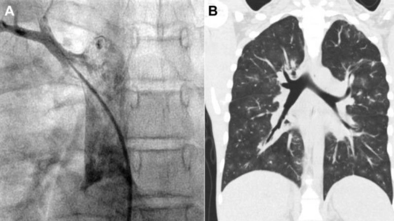 Partial anomalous pulmonary venous return echo in diagnosis