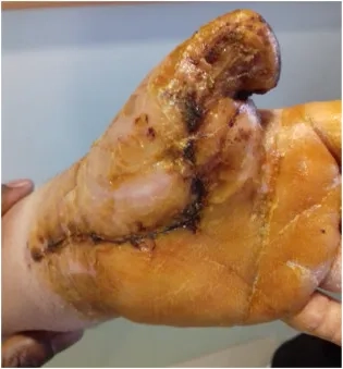 A patient with a serious infection from a dog bite