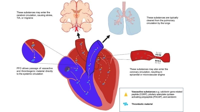 Patent foramen ovale closure procedure to seal heart opening
