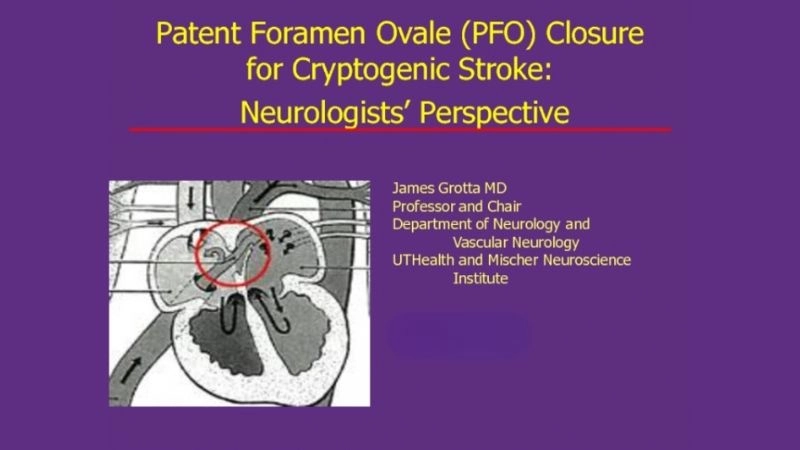 Patent foramen ovale and migraines possible heart brain connection