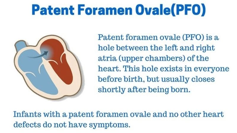 Patent foramen ovale and diving risks of decompression illness