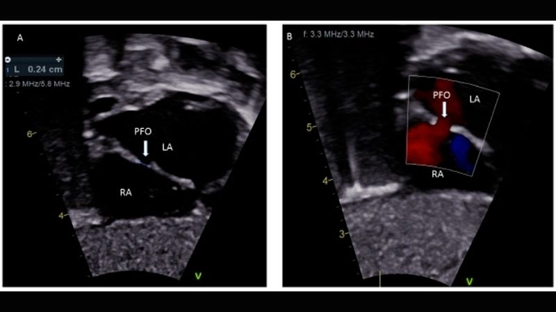 PFO diagnosis tests to detect hidden heart condition