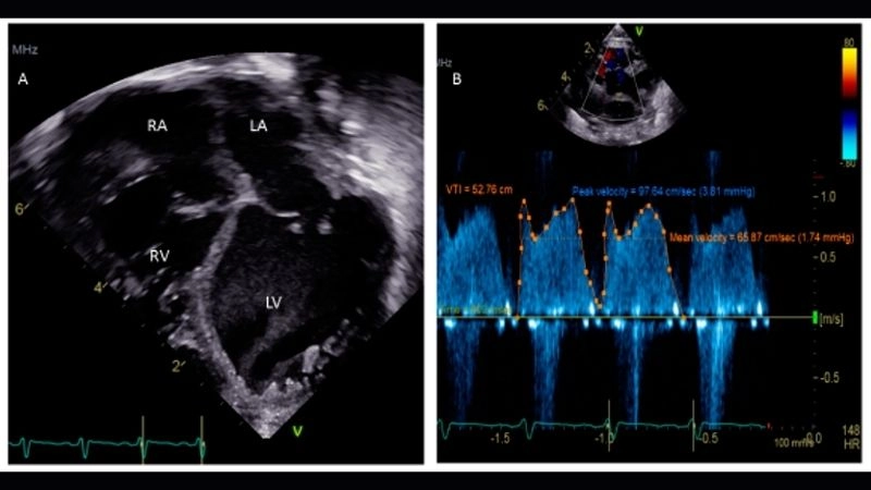 Patent foramen ovale in adults often undiagnosed until later