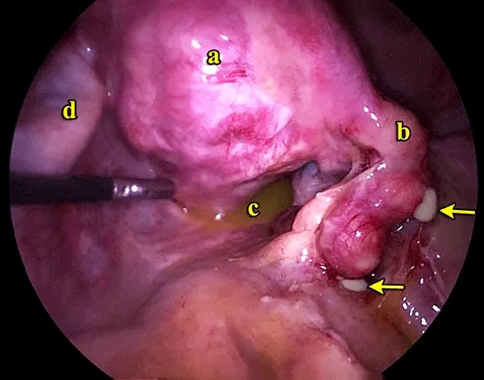 Clarifying the question: is PID an STD