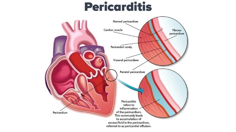 Pericardial effusion treatment medical and surgical approaches