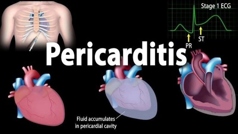 Pericarditis symptoms warning signs of heart inflammation