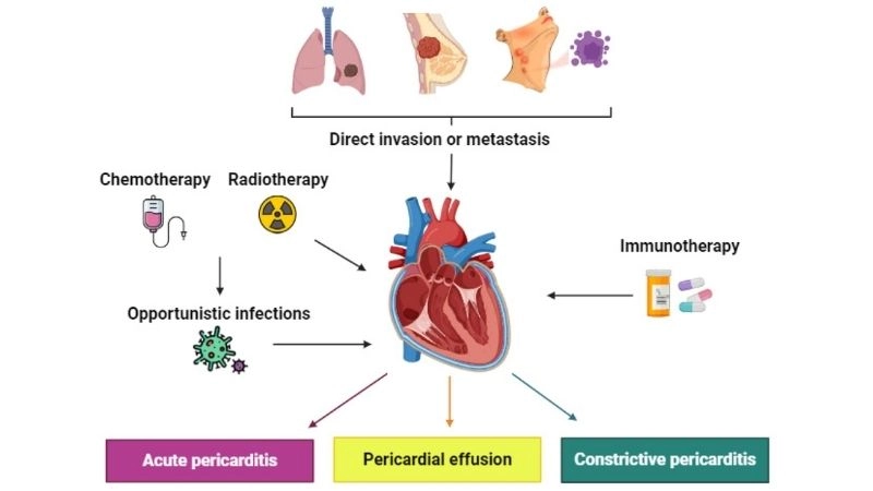 Pericarditis chest pain sharp discomfort linked to the disease