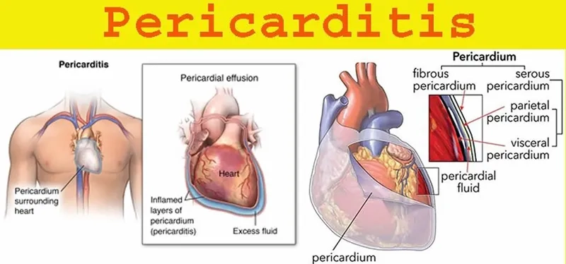 The long-term effects of chronic pericarditis