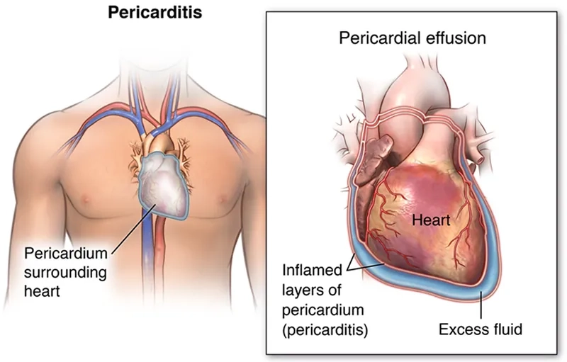 Ultrasound image showing a pericardial effusion