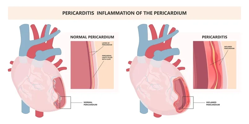 Common causes of pericarditis illustrated