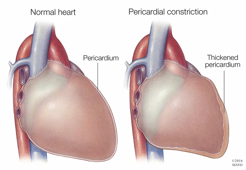 Recognizing the key pericarditis symptoms