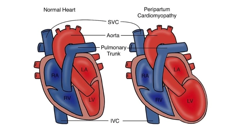 Peripartum cardiomyopathy diagnosis needs timely check