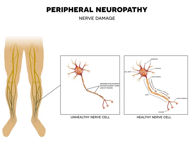 A diagram showing neuropathy in feet