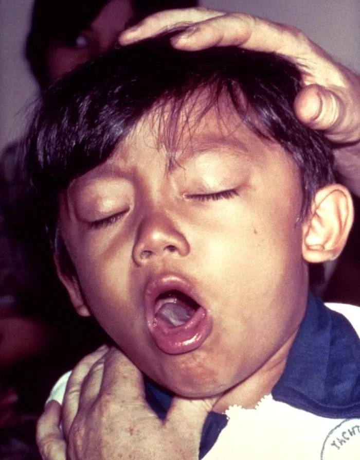 A child receiving the essential pertussis vaccine