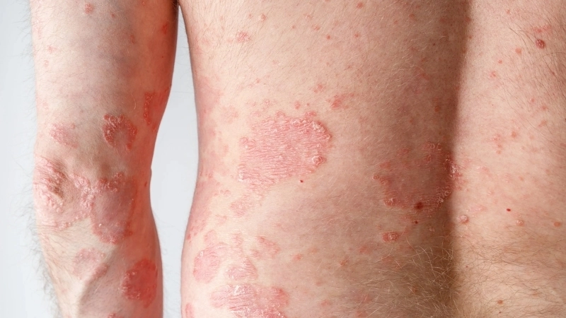 Pityriasis rosea pregnancy risks and care