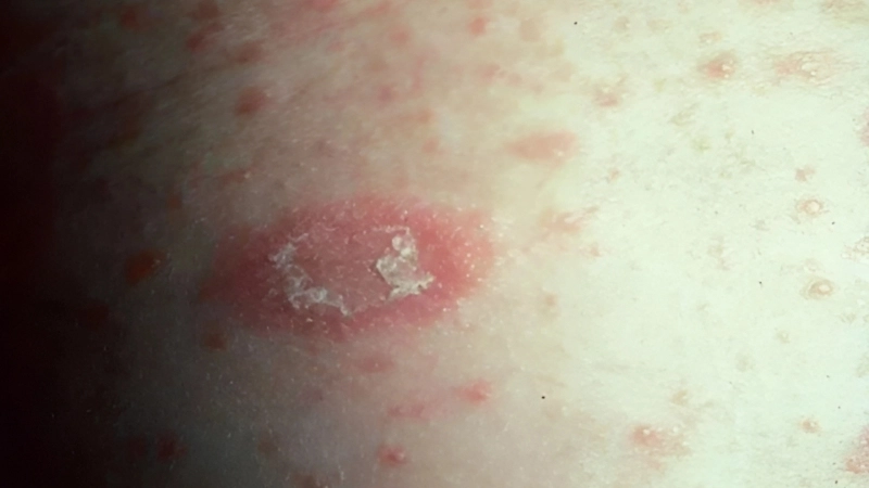 Common pityriasis rosea causes explained