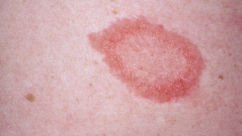 Typical pityriasis rosea symptoms appear
