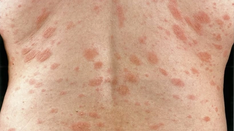 Average pityriasis rosea duration in weeks