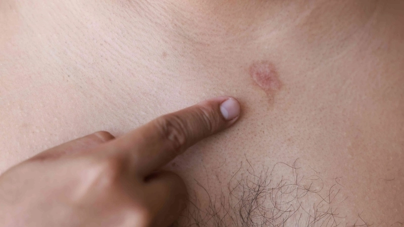 Differences pityriasis rosea vs ringworm